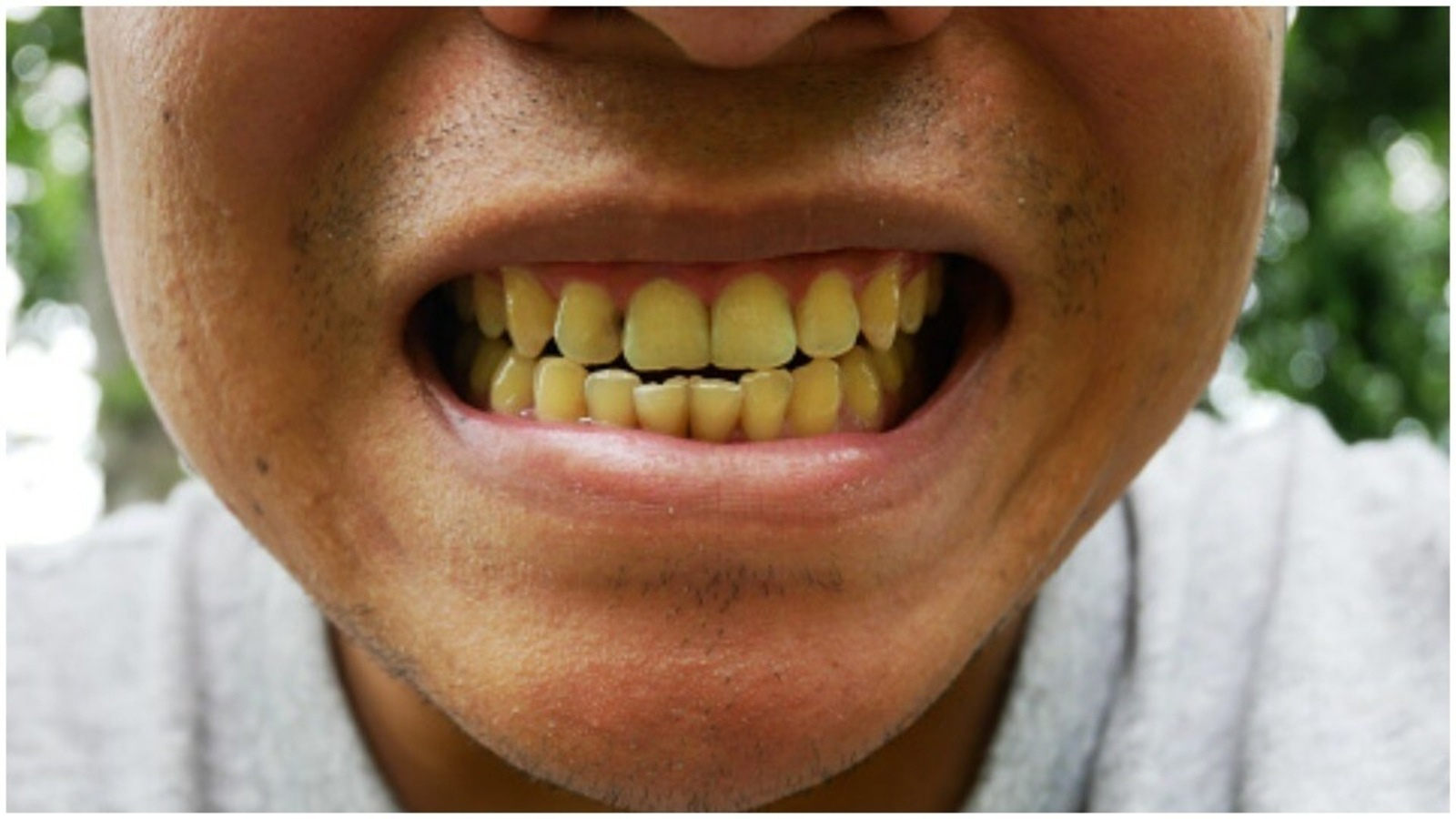 фото гниющих зубов