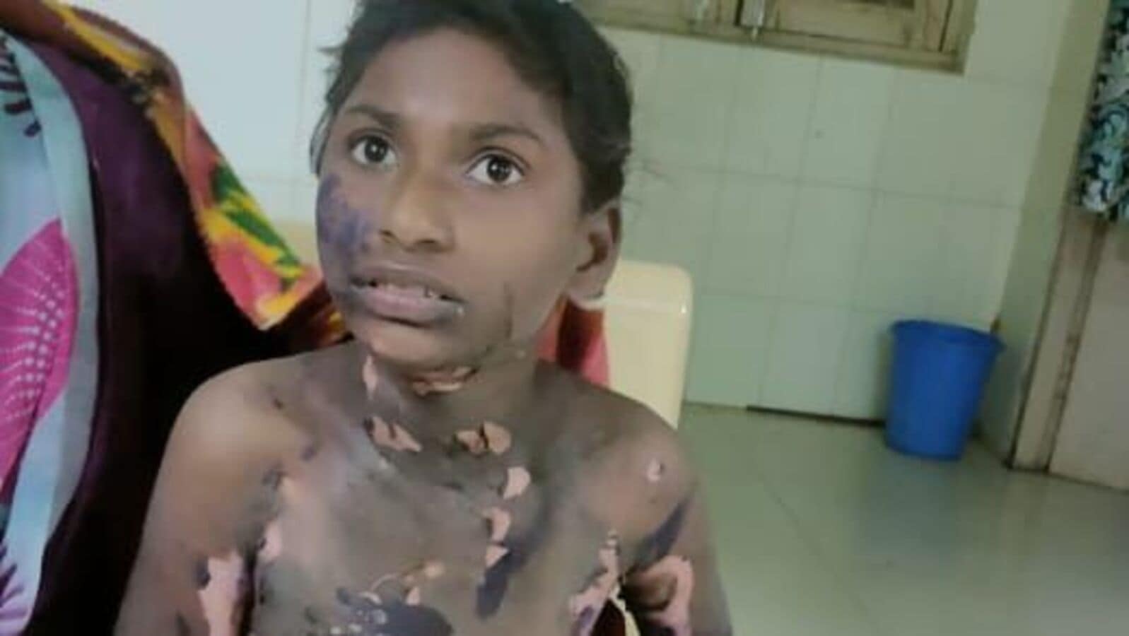 Fire Accident: చలి మంటల్లో పడి బాలికకు గాయాలు