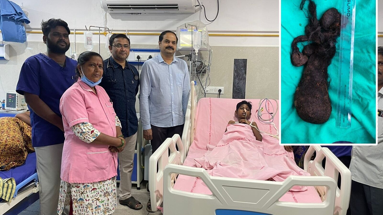 Khammam News : 11 ఏళ్ల చిన్నారి కడుపులో వెంట్రుకలు, ఖమ్మం హాస్పిటల్ లో అరుదైన చికిత్స