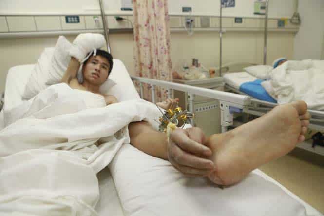 Xiao Wei's severed right hand is seen attached to his ankle before the reattachment surgery at Xiangya Hospital in Changsha, Hunan province. (Reuters)</em)