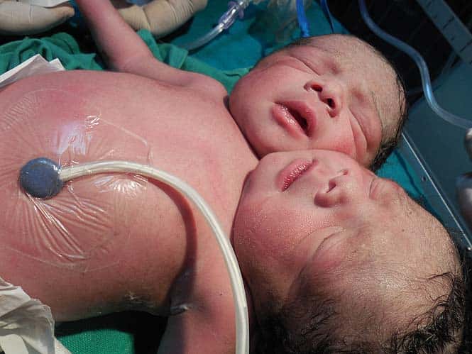 Conjoined twins born in Sonepat. HT Photo