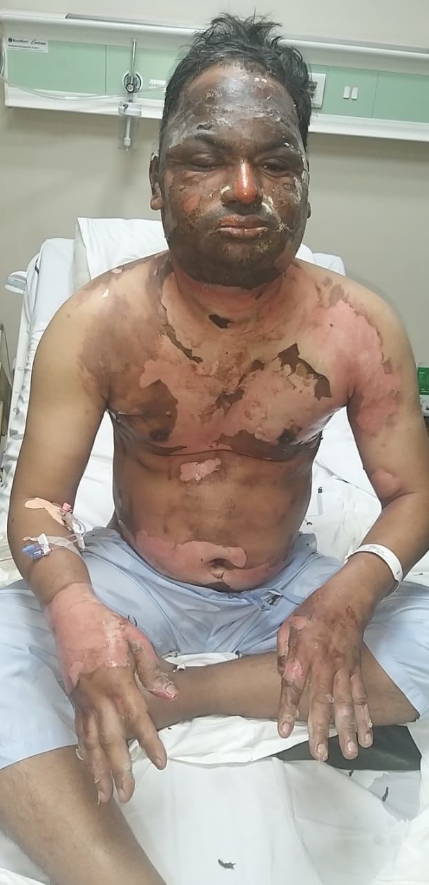 ঝলসে গেল শরীর ঝলসে গেল শরীর