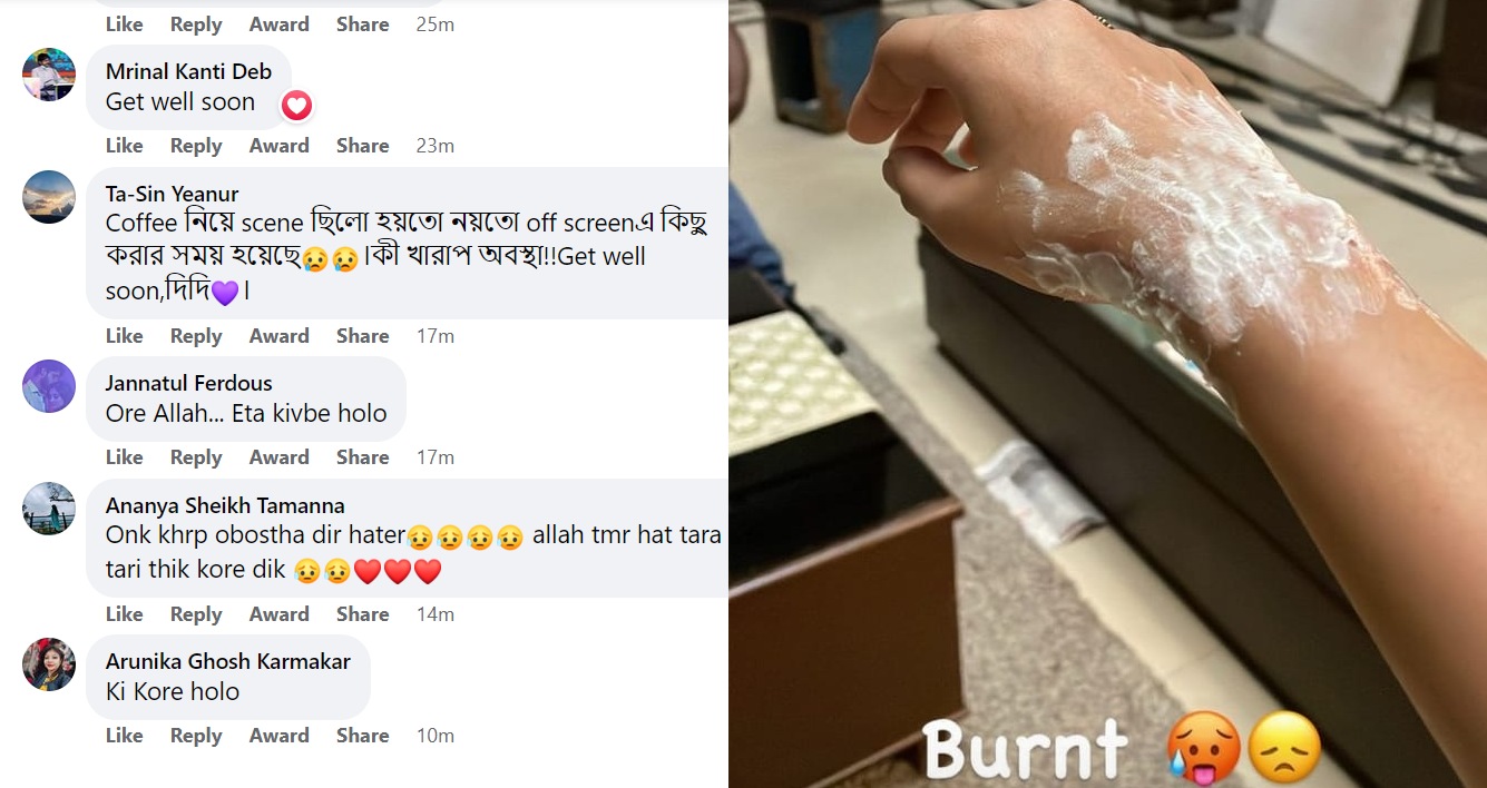 হাত পুড়ে গিয়েছে তন্বীর হাত পুড়ে গিয়েছে তন্বীর