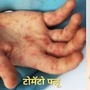 टोमॅटो फ्लू आणि मंकीपॉक्स यातील फरक <p>टोमॅटो फ्लू आणि मंकीपॉक्स यातील फरक</p>