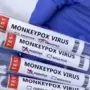 मंकीपॉक्स, कोविड १९ आणि HIV <p>मंकीपॉक्स, कोविड १९ आणि HIV</p>