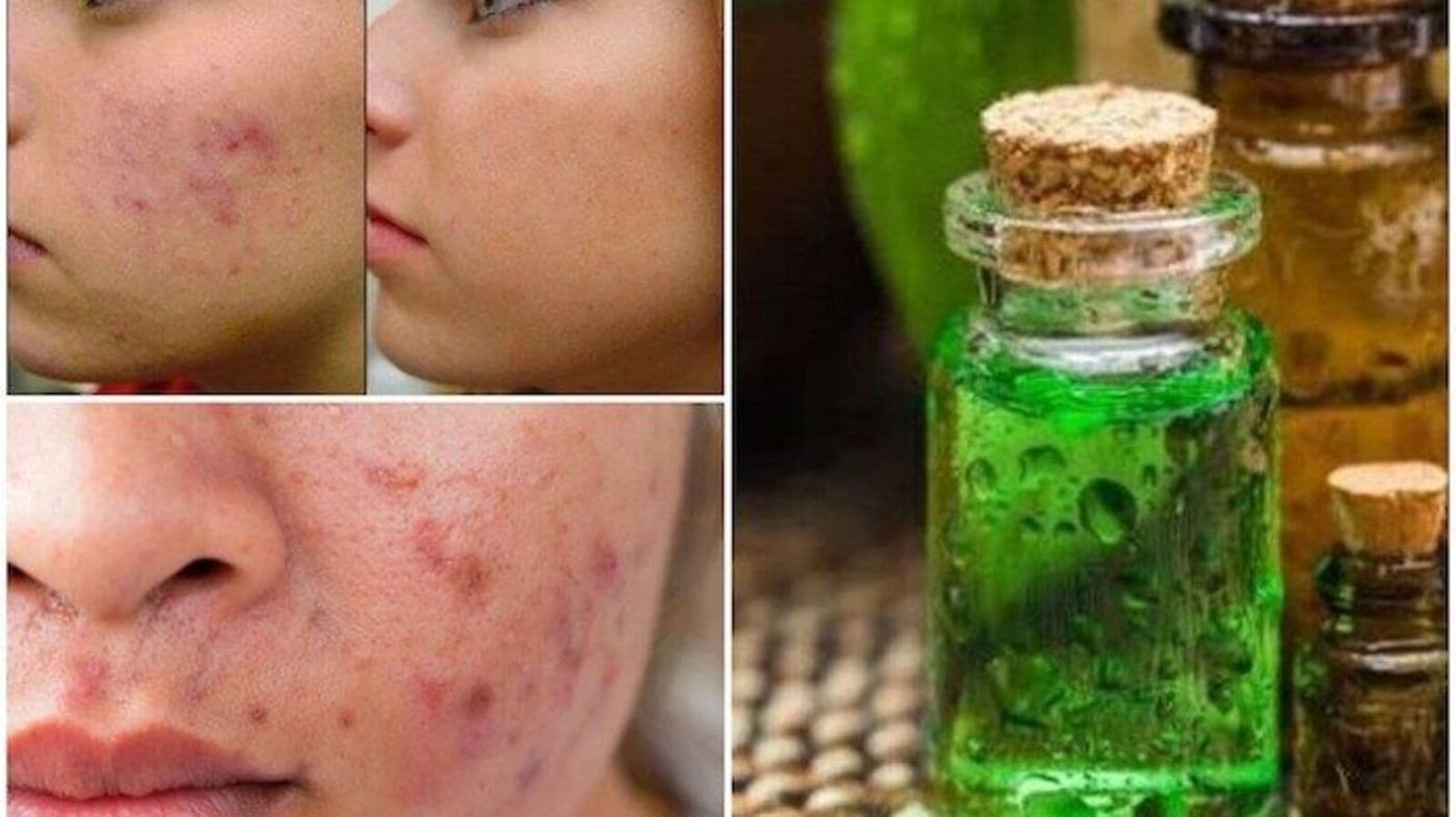 Tea Tree Oil Benefits: ত্বক এবং চুলের সমস্যায় নাজেহাল? টি ট্রি অয়েল  কীভাবে ব্যবহার করবেন দেখুন, টুকিটাকি নিউজ