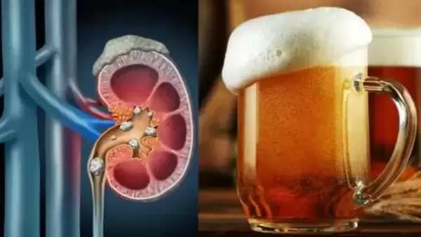 beer-and-kidney-stones