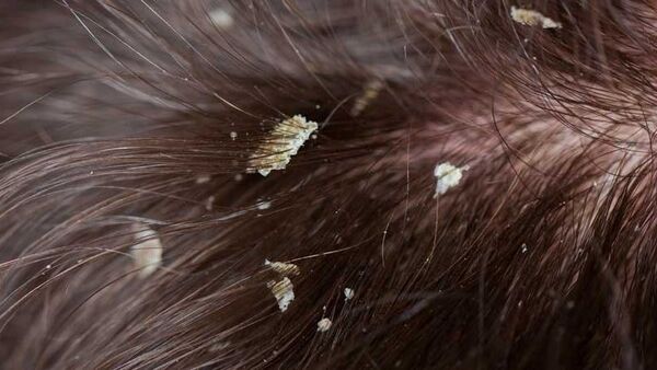 Dandruff Easy Remedies: খুশকির সমস্যায় ভুগছেন? এক পাতার কেরামতিতেই মিটবে সমস্যা – Neem can easily solve dandruff problem