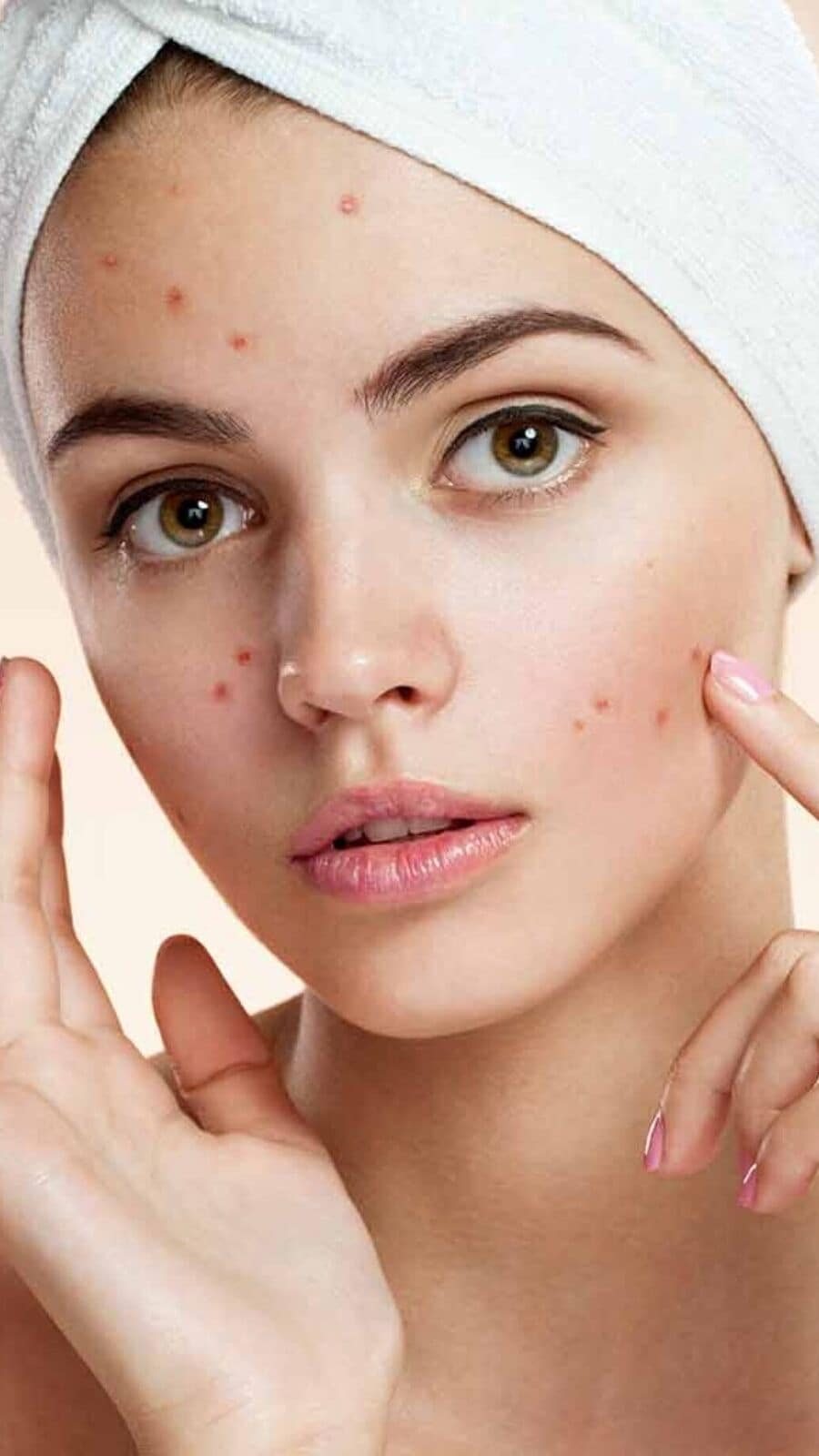 Acne Makeup Tips: কীভাবে মেকআপের সাহায্যে ব্রণ ঢাকবেন? রইল টিপস