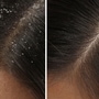 Home remedies for dandruff (shutterstock) Home remedies for dandruff (shutterstock)