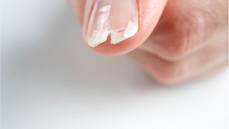 অনেকের নখের উপর উল্লম্ব সরলরেখার মতো কিছু দাগ দেখা যায়। প্রখয়ই এই দাগ আমাদের চোখ এড়িয়ে যায়। অনেকে হয়তো ততটা গুরুত্বও দেন না। কিন্তু এই দাগ শরীরের কিছু রোগের লক্ষণ বলেই জানাচ্ছেন চিকিৎসক কুণাল সুদ। 