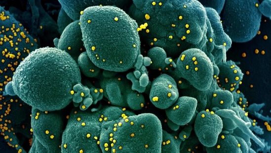 Colorized scanning electron micrograph of an apoptotic cell (green) infected with SARS-COV-2 virus particles (yellow), also known as novel coronavirus, isolated from a patient sample(REUTERS) Colorized scanning electron micrograph of an apoptotic cell (green) infected with SARS-COV-2 virus particles (yellow), also known as novel coronavirus, isolated from a patient sample(REUTERS)