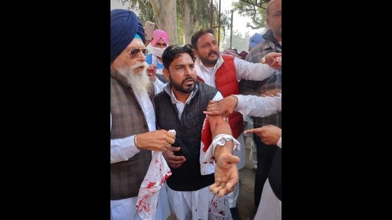 A Shiromani Akali Dal activist showing injuries suffered after the clash with Congress supporters at the Jalalabad tehsil complex on Tuesday. (Sanjeev Kumar/HT)