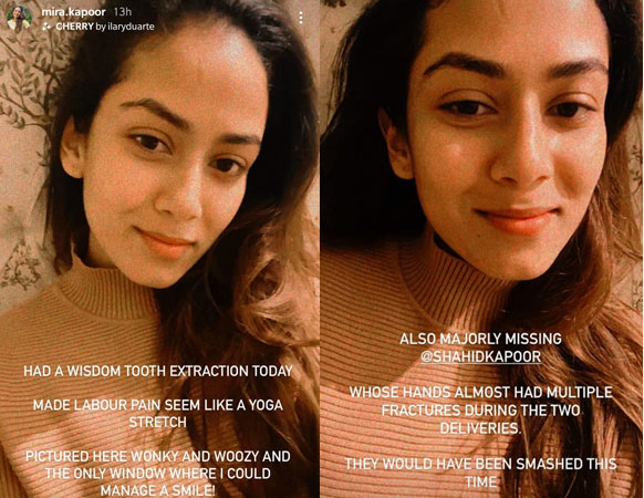 Mira Rajput has shared two selfies on her Instagram Stories after undergoing tooth extraction. Mira Rajput has shared two selfies on her Instagram Stories after undergoing tooth extraction.