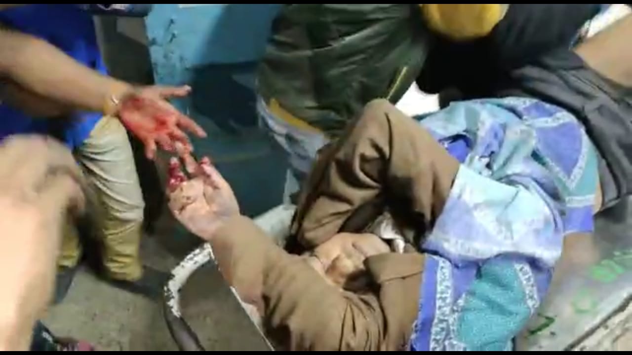 The minister sustained injuries on the left side, mainly on the leg.(HT Photo) The minister sustained injuries on the left side, mainly on the leg.(HT Photo)