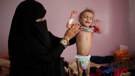 FILE - In this Nov. 23, 2019 file photo, a woman holds her malnourished boy at a feeding center at the Al-Sabeen Hospital in Sanaa, Yemen. After a visit to Yemen the World Food Program's executive director, David Beasley, warned that his underfunded organization may be forced seek hundreds of millions of dollars in private donations in a desperate bid to stave off widespread famine in the coming months. Beasley told The Associated Press in an interview Wednesday, March 10, 2021, that conditions in war-wrecked Yemen are “hell.” (AP Photo/Hani Mohammed, File) (AP) FILE - In this Nov. 23, 2019 file photo, a woman holds her malnourished boy at a feeding center at the Al-Sabeen Hospital in Sanaa, Yemen. After a visit to Yemen the World Food Program's executive director, David Beasley, warned that his underfunded organization may be forced seek hundreds of millions of dollars in private donations in a desperate bid to stave off widespread famine in the coming months. Beasley told The Associated Press in an interview Wednesday, March 10, 2021, that conditions in war-wrecked Yemen are “hell.” (AP Photo/Hani Mohammed, File) (AP)