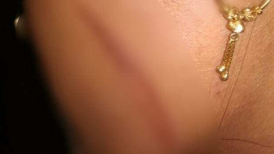 The woman's burnt cheek. (HT Photo) The woman's burnt cheek. (HT Photo)