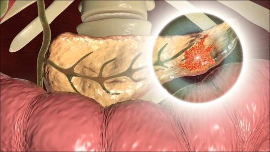 Researchers discover a good target for tumour therapies to prevent metastasis (Twitter/ClinicalOMICs) Researchers discover a good target for tumour therapies to prevent metastasis (Twitter/ClinicalOMICs)