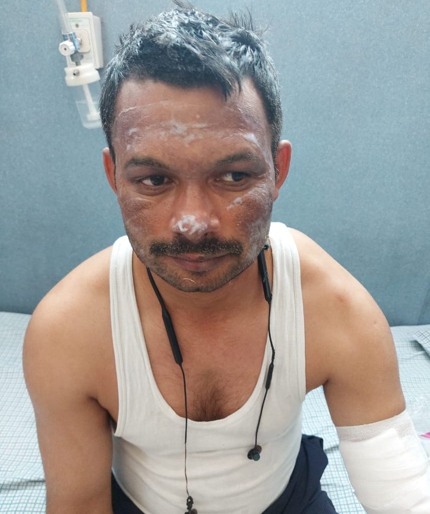 Ghaziabad Police constable Arun Kumar undergoes treatment after rescuing people from a fire accident at NH 9 in Dasna on the intervening night of April 10 and 11, in Ghaziabad. (Sakib Ali /Hindustan Times) Ghaziabad Police constable Arun Kumar undergoes treatment after rescuing people from a fire accident at NH 9 in Dasna on the intervening night of April 10 and 11, in Ghaziabad. (Sakib Ali /Hindustan Times)