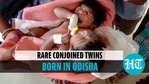A woman gave birth to rare conjoined twin daughters with two heads and three hands A woman gave birth to rare conjoined twin daughters with two heads and three hands