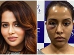 Raiza Wilson said that a dermatological treatment suggested by Dr Bhairavi Senthil put her life at risk. Raiza Wilson said that a dermatological treatment suggested by Dr Bhairavi Senthil put her life at risk.