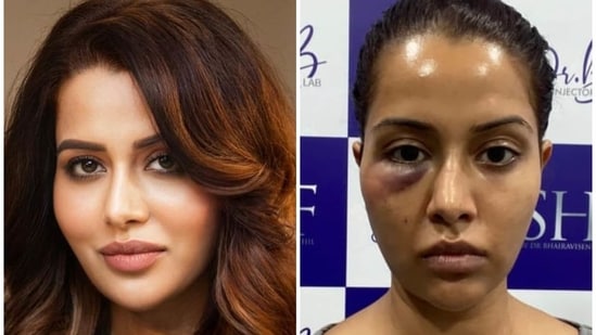 Raiza Wilson said that a dermatological treatment suggested by Dr Bhairavi Senthil put her life at risk.