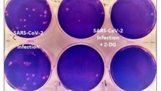 Comparison of cells infected with SARS-CoV-2 and infected cells treated with 2-DG. (Photo: PIB)
