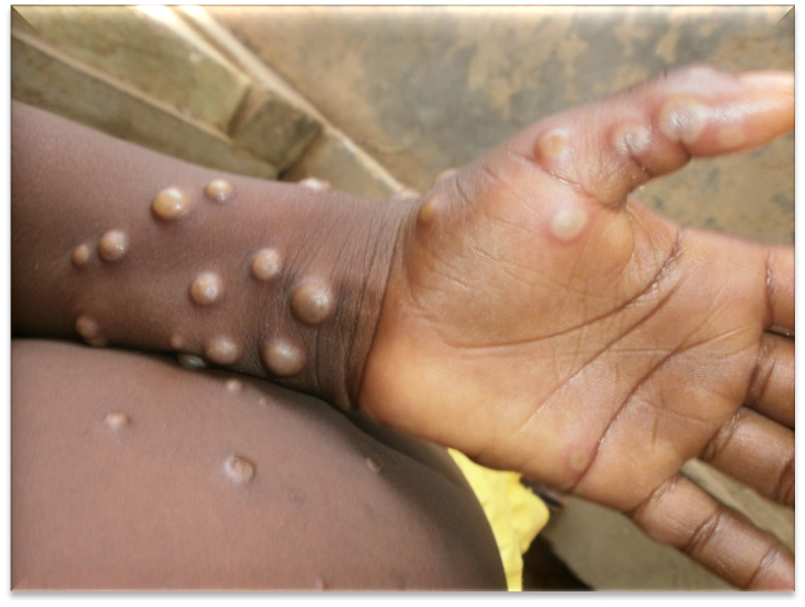 The common symptoms of monkeypox are common cold and flu-like symptoms, fever or exhaustion, headache, backache, muscle pain, swollen lymph nodes, fatigue among others (WHO)