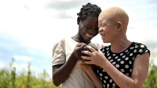 The theme of the international albinism awareness day is 'Strength Beyond All Odds' this year. (AP) The theme of the international albinism awareness day is 'Strength Beyond All Odds' this year. (AP)