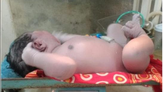 Assam baby weighs 5.2 kgs at birth, doctors call it state record Assam baby weighs 5.2 kgs at birth, doctors call it state record
