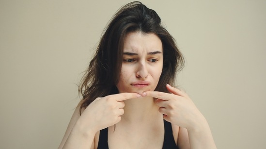 Before applying all these products to your face, make sure to do a skin test since some of these items may not suit your face and might irritate the skin. These natural remedies have been used for a long time but the science behind them is unclear.(Pexels)