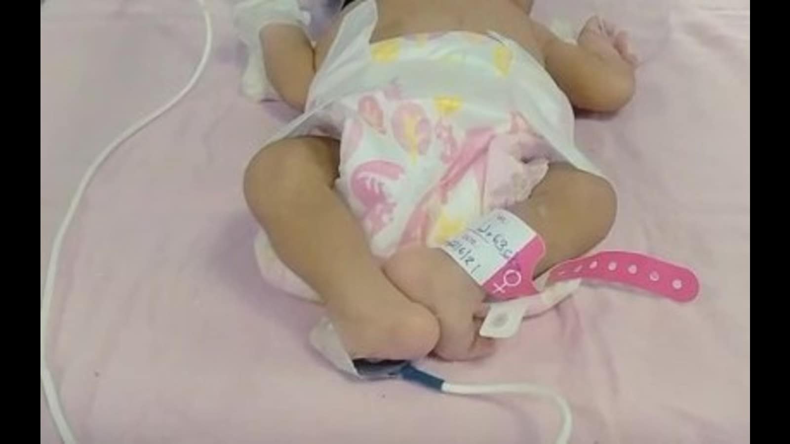 MP couple abandons newborn with clubfoot, returns after hospital reaches out: Doc