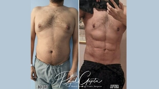 Gynecomastia correction along with high definition liposuction of abdomen done in this patient by Dr Rajat Gupta