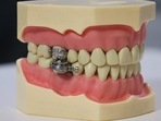 Weight loss device uses magnets to lock the jaw shut and have a liquid diet Weight loss device uses magnets to lock the jaw shut and have a liquid diet
