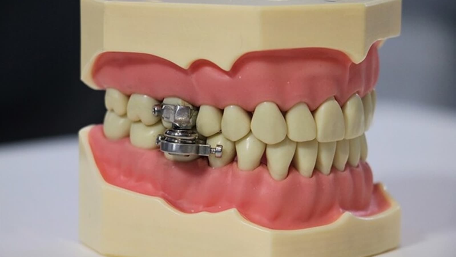 Weightloss device uses to lock the jaw shut, restricts users