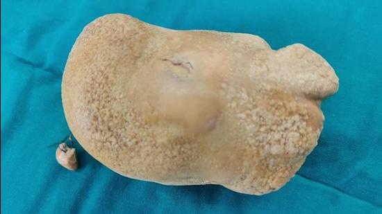The stone removed from the boy’s urinary bladder. (Sourced)