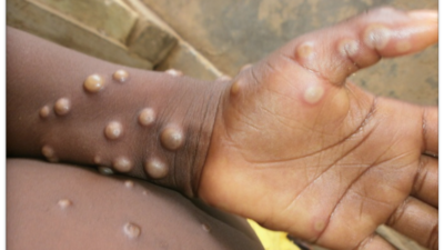 Monkeypox, which belongs to the same family of viruses as smallpox, is a rare but potentially serious viral illness (CDC) Monkeypox, which belongs to the same family of viruses as smallpox, is a rare but potentially serious viral illness (CDC)