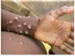 The first case of monkeypox in humans was recorded in 1970 in the Democratic Republic of Congo(CDC)