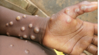 The first case of monkeypox in humans was recorded in 1970 in the Democratic Republic of Congo (CDC)
