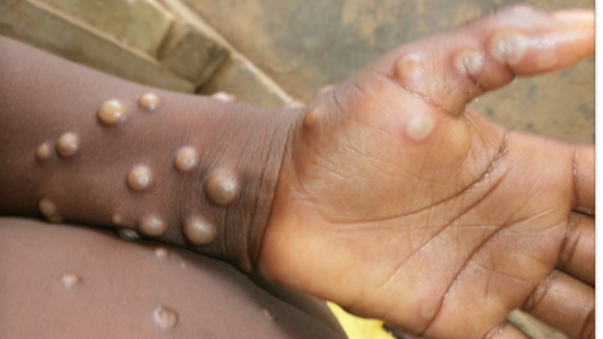 The first case of monkeypox in humans was recorded in 1970 in the Democratic Republic of Congo(CDC)