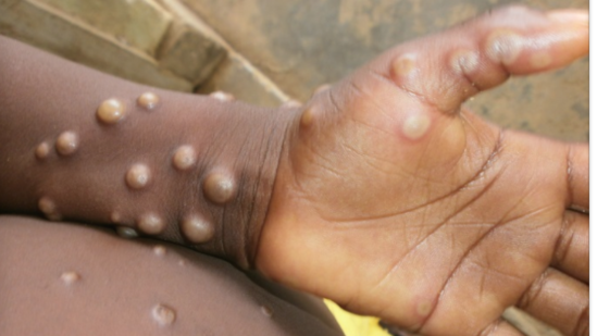 CDC Confirms Case of Monkeypox in US Resident – Dr. Daliah