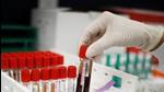 Through July, 11 people have succumbed to the virus in the tricity, including eight in Mohali, two in Panchkula and one in Chandigarh. (REUTERS) Through July, 11 people have succumbed to the virus in the tricity, including eight in Mohali, two in Panchkula and one in Chandigarh. (REUTERS)