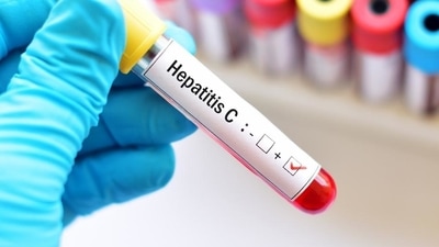 Hepatitis is a group of infectious diseases known by its various variants, like A, B, C, D, and E.Hepatitis is a group of infectious diseases known by its various variants, like A, B, C, D, and E. (HT File Photo) Hepatitis is a group of infectious diseases known by its various variants, like A, B, C, D, and E.Hepatitis is a group of infectious diseases known by its various variants, like A, B, C, D, and E. (HT File Photo)