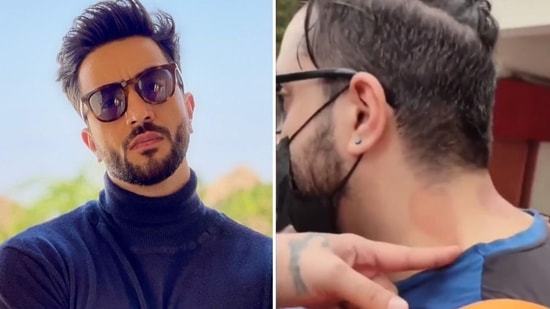 Aly Goni blushed as he was asked about the marks on his neck.