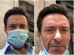 Hugh Jackson has been treated basal cell carcinoma, the least dangerous of skin cancers, five times in the past. Hugh Jackson has been treated basal cell carcinoma, the least dangerous of skin cancers, five times in the past.
