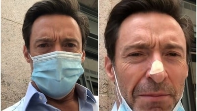 Hugh Jackson has been treated basal cell carcinoma, the least dangerous of skin cancers, five times in the past.