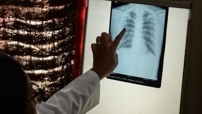 India has seen a fall of 25% in the number of tuberculosis cases reported in 2020 as compared to the previous year. (HT FILE PHOTO) India has seen a fall of 25% in the number of tuberculosis cases reported in 2020 as compared to the previous year. (HT FILE PHOTO)