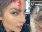 Priyanka Chopra gets hurt during the making of Citadel. Priyanka Chopra gets hurt during the making of Citadel.