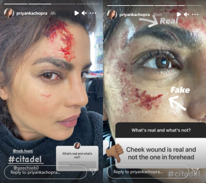 Priyanka Chopra shared a picture of her wound.