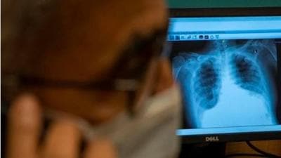 A study from China published in the PLOS One journal in March found that patients who had a severe clinical classification of Covid-19 had more extensive and severe lung inflammation as well as severe residual pulmonary fibrosis. (Reuters) A study from China published in the PLOS One journal in March found that patients who had a severe clinical classification of Covid-19 had more extensive and severe lung inflammation as well as severe residual pulmonary fibrosis. (Reuters)